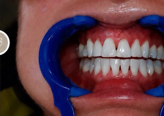 Composite bonding after treatment