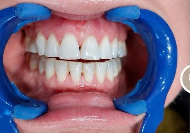 Composite bonding before treatment