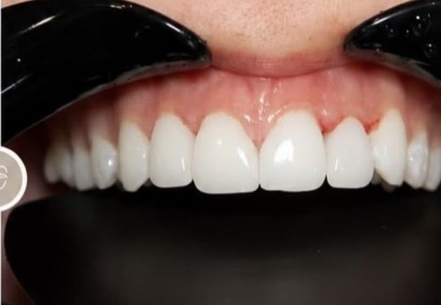 Crowns and bridges after treatment