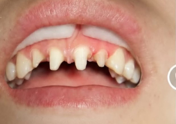 Crowns and bridges before treatment