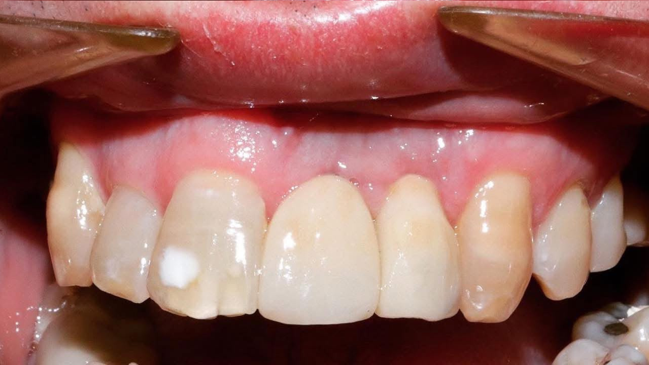 Dental implants after treatment