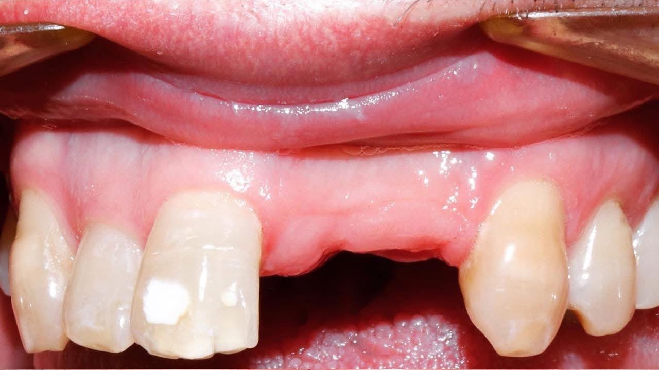 Dental implants before treatment