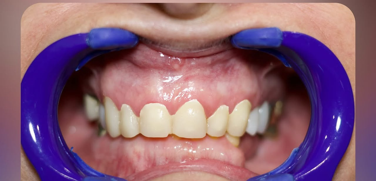 Full mouth rehabilitation after treatment
