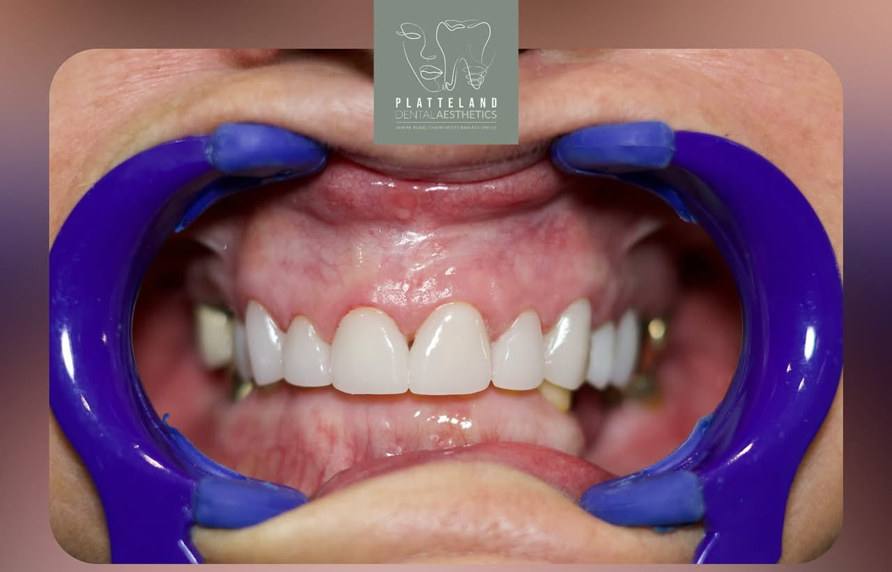 Full mouth rehabilitation before treatment