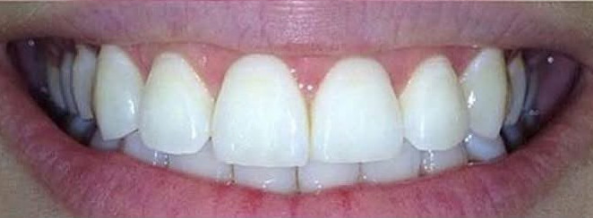 Invisalign after treatment