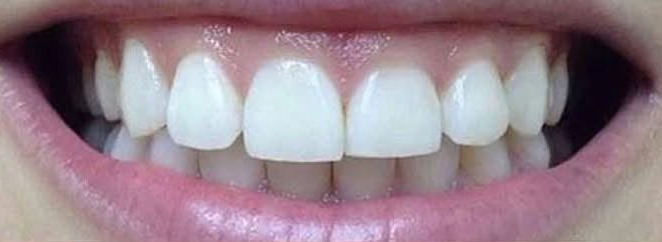 Invisalign before treatment
