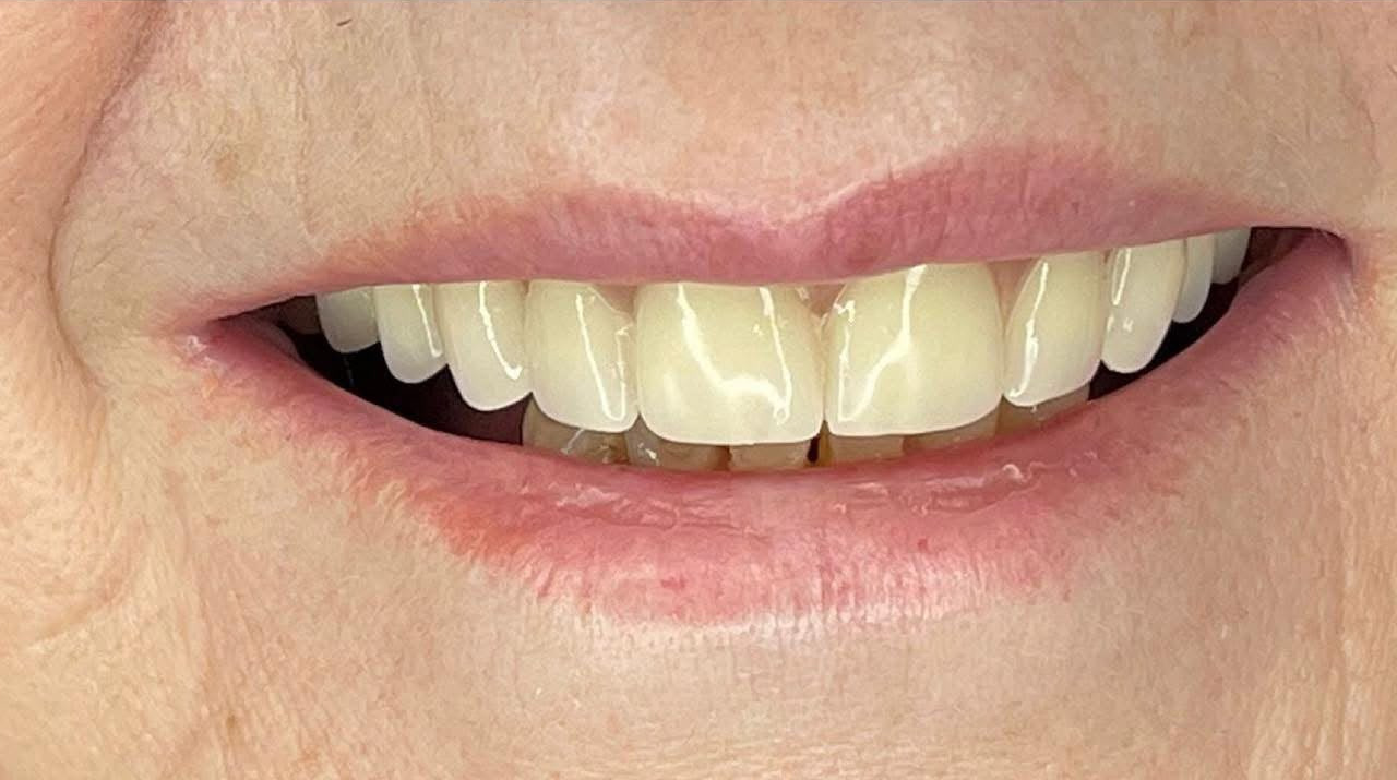 Smile makeover after treatment