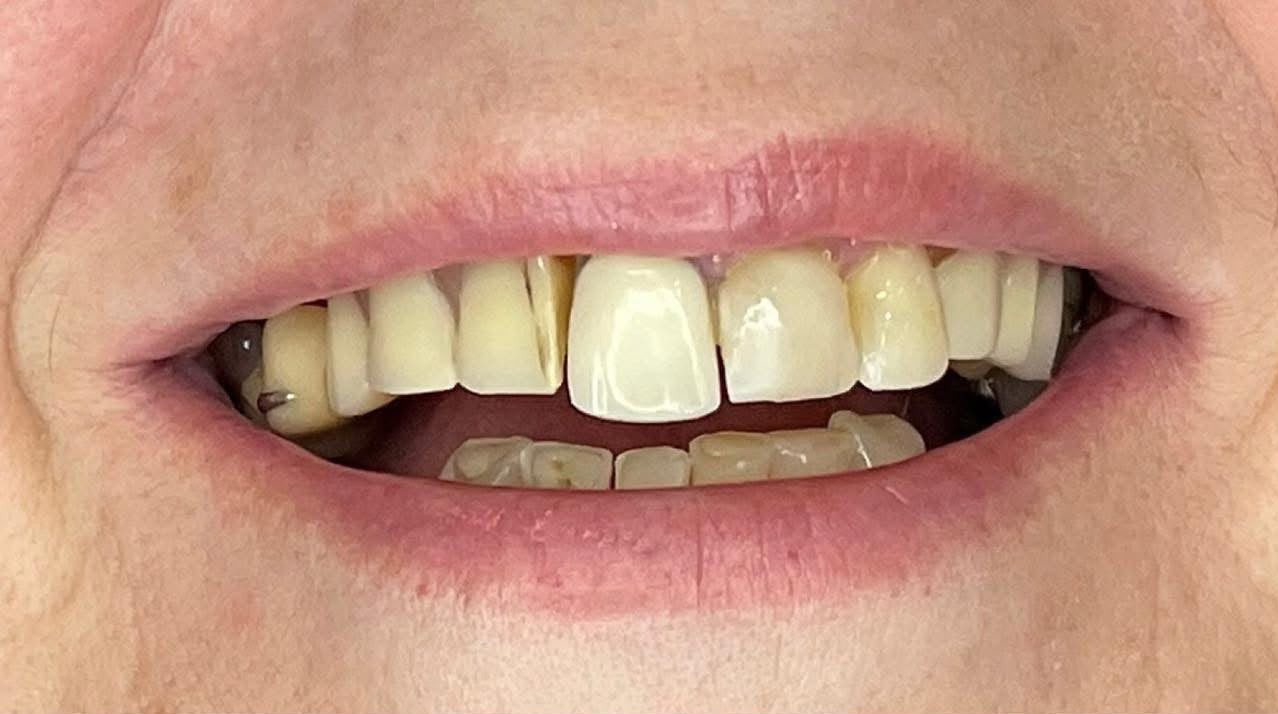 Smile makeover before treatment