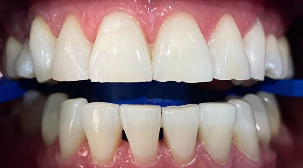 Teeth whitening after treatment