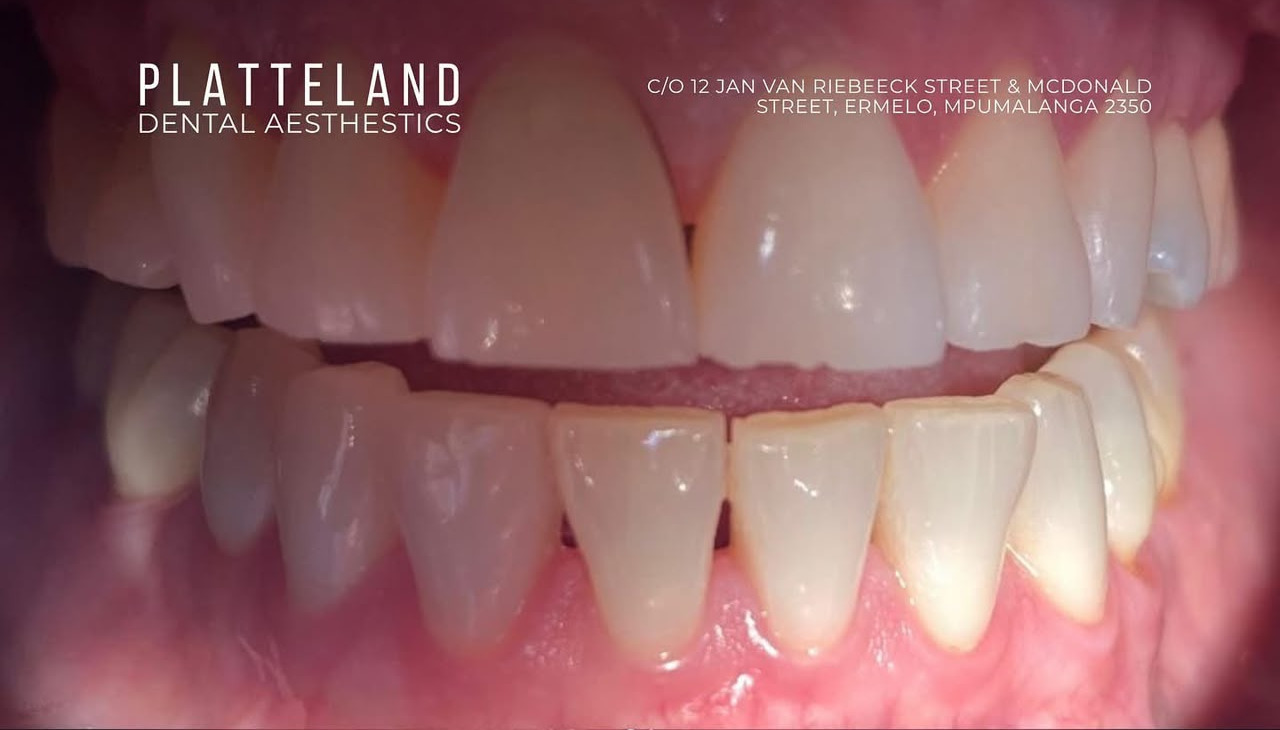Teeth whitening before treatment
