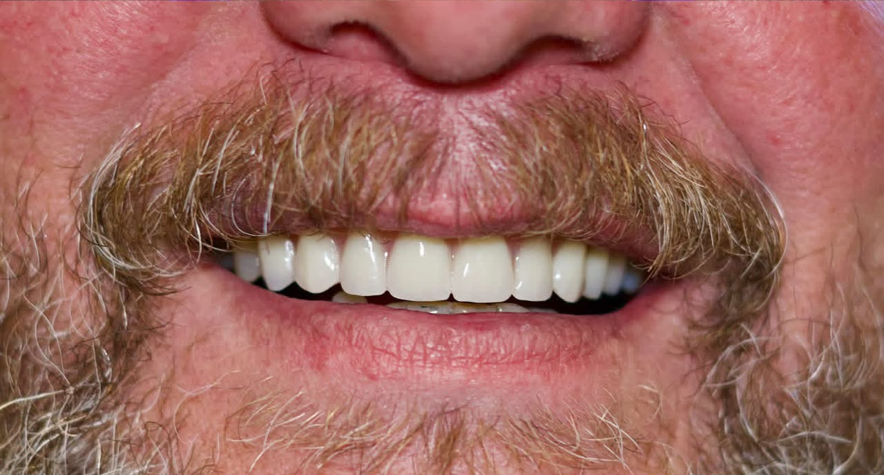 Veneers after treatment