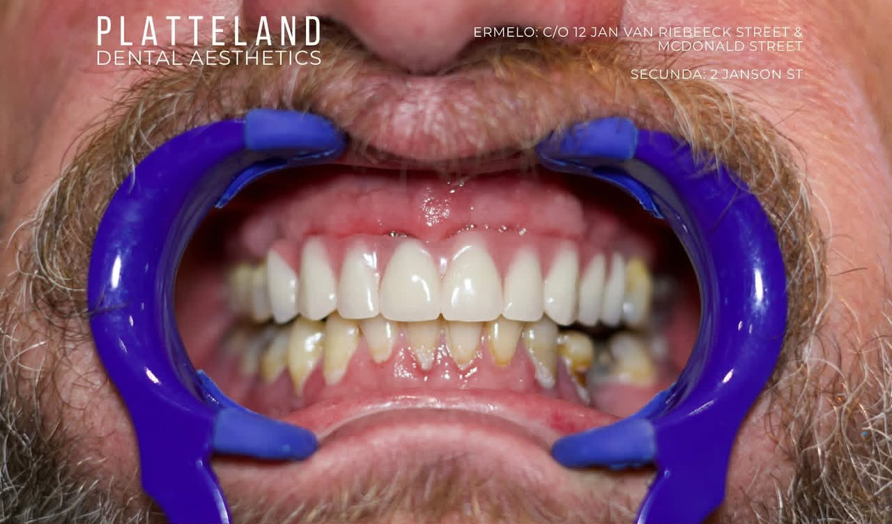 Veneers before treatment